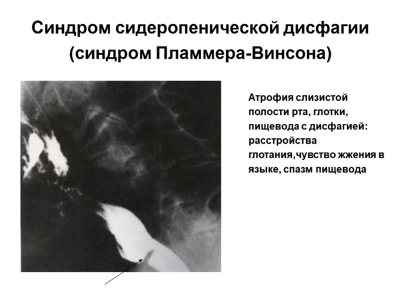Синдром сидеропенической дисфагии (синдром Пламмера-Винсона) Атрофия слизистой полости рта, глотки, пищевода с дисфагией: расстройства